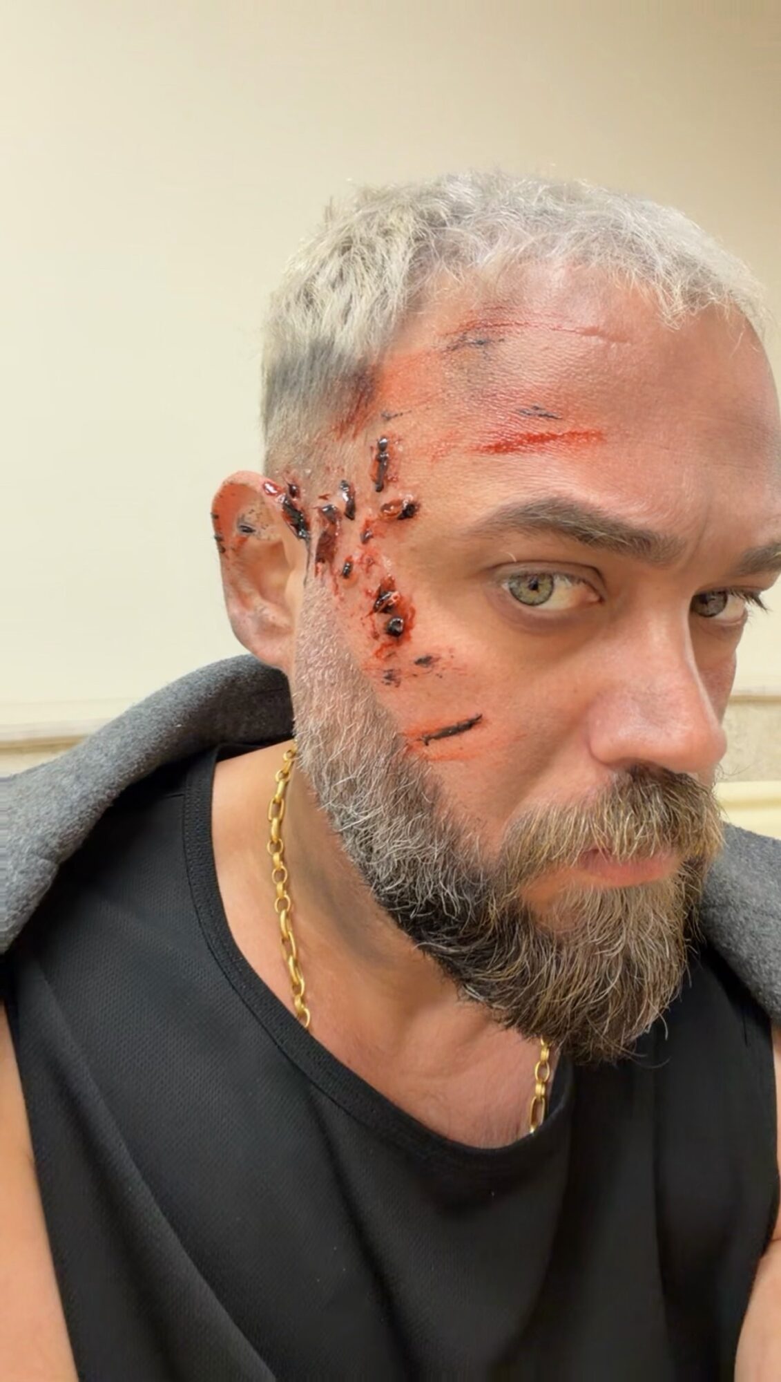 Man with short gray hair and beard has facial injuries and scratches, wearing a black shirt and gold chain.