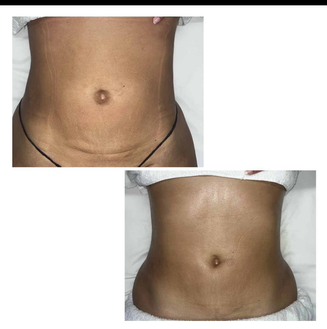 Close-up of a person's bare abdomen with visible stretch marks and a slightly protruding belly button.