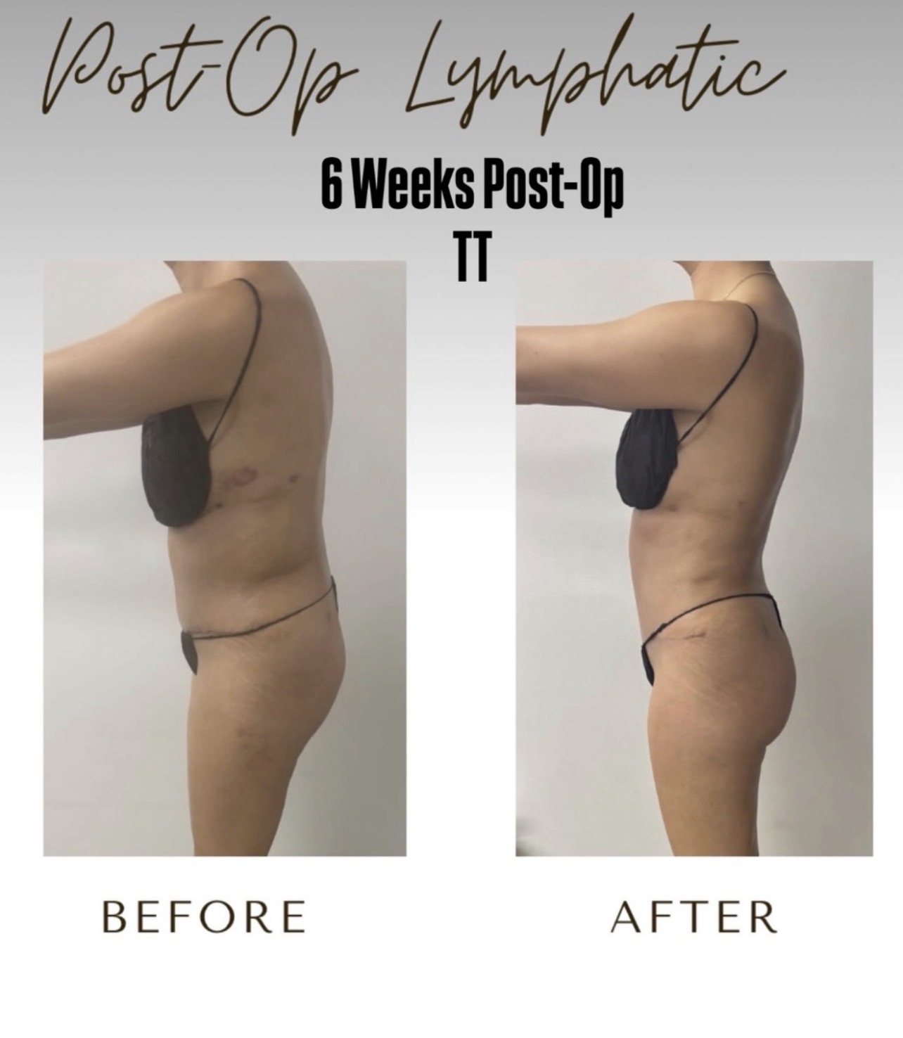 Side-by-side comparison of a person's torso before and after post-op lymphatic surgery, six weeks post-operation, showing visible changes.
