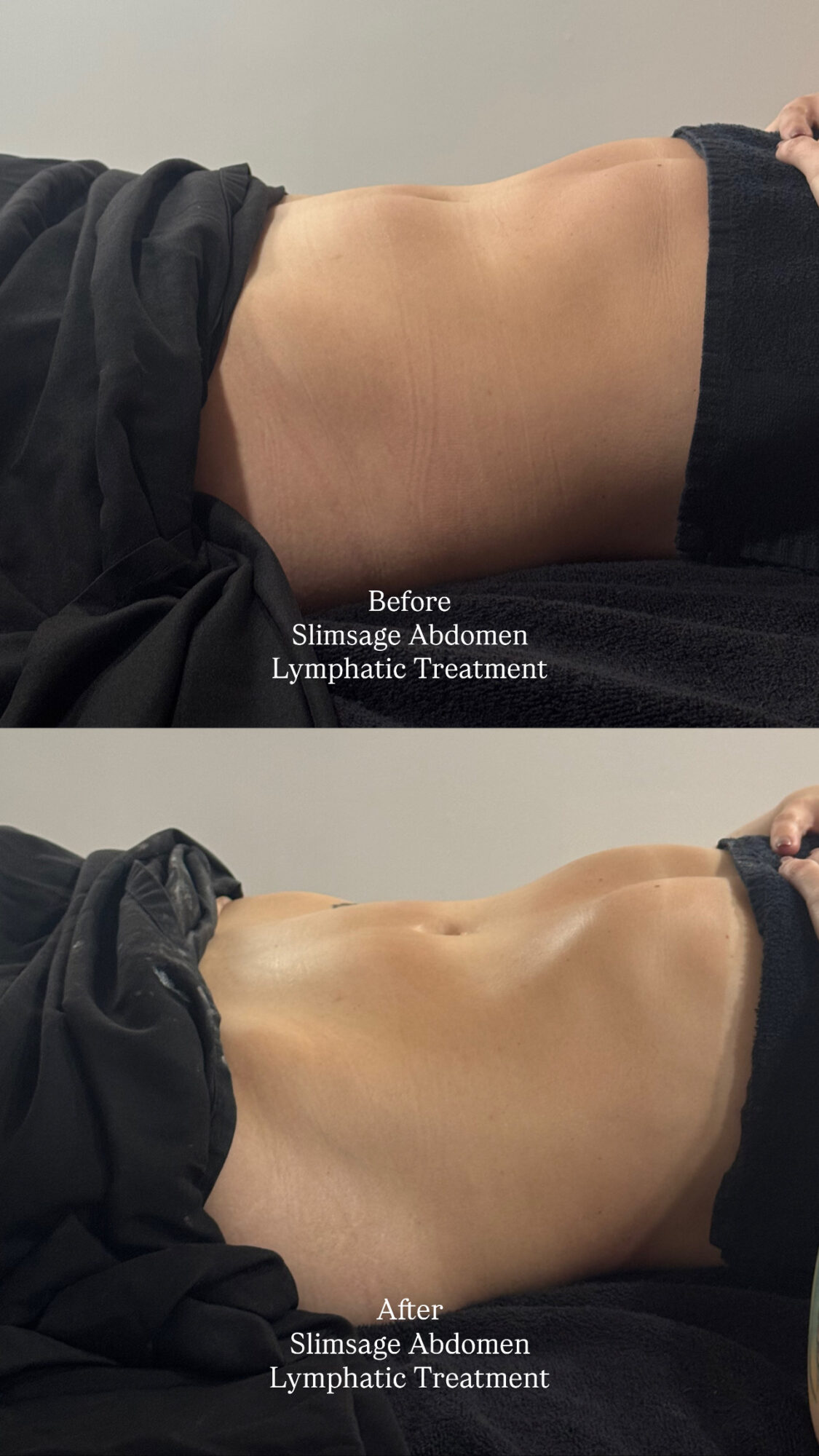 Comparison of abdomen before and after slimming treatment, showing reduced size and improved contour, with text labels.