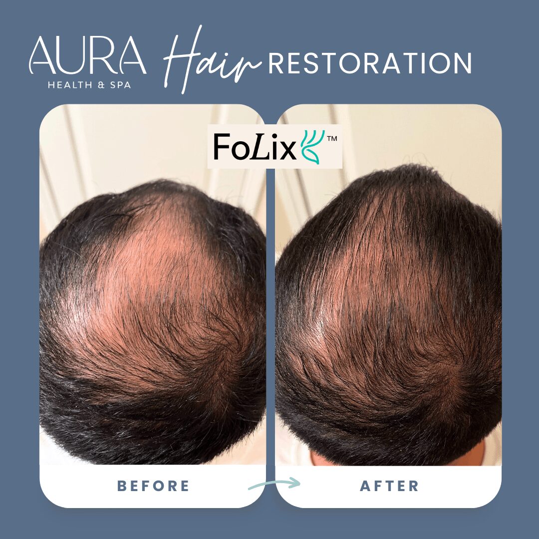 Comparison of a person's scalp showing hair loss before and after treatment, with visible hair growth in the after image.