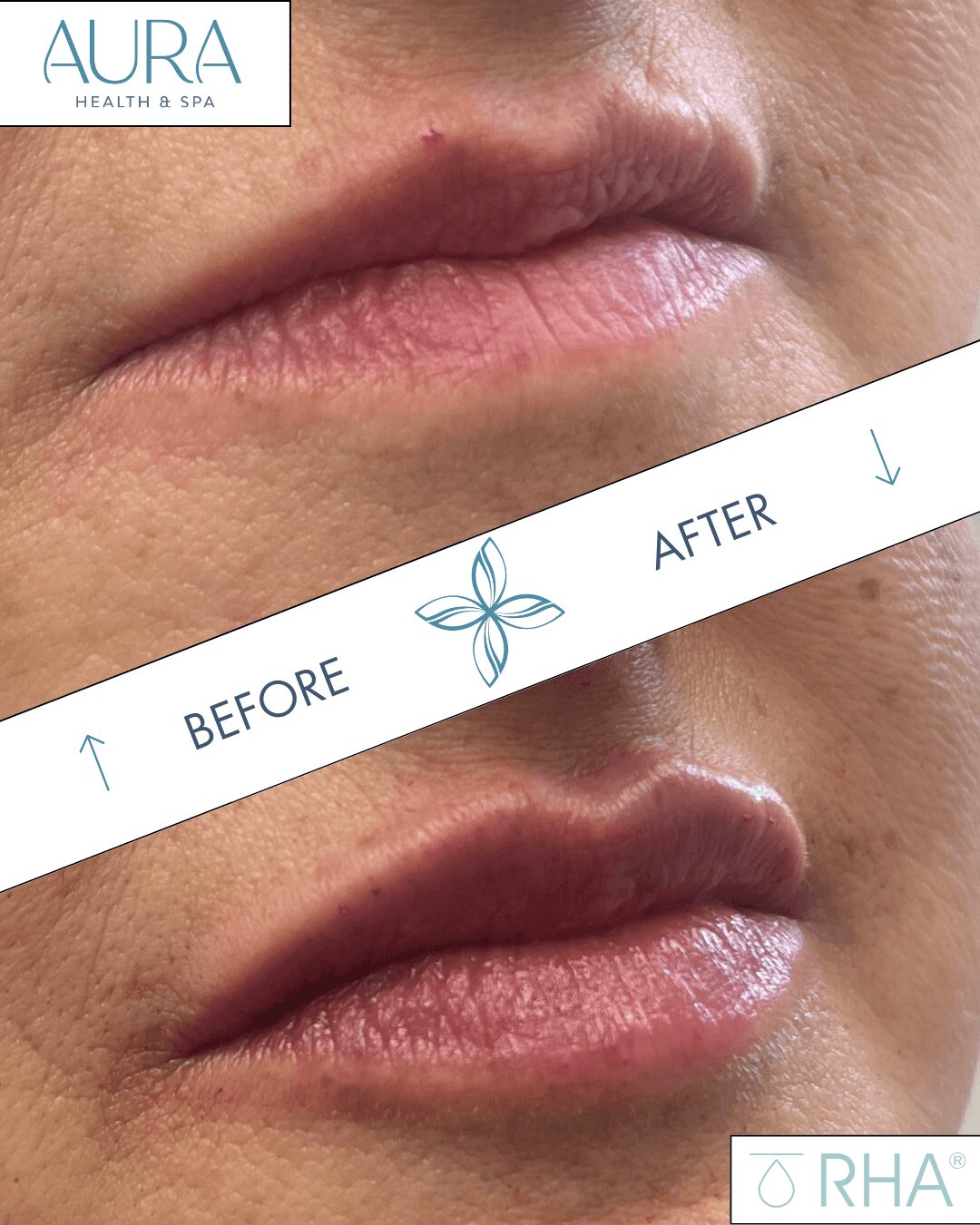Close-up of lips before and after treatment, showing improved skin and lip appearance, with a logo in the top left corner.