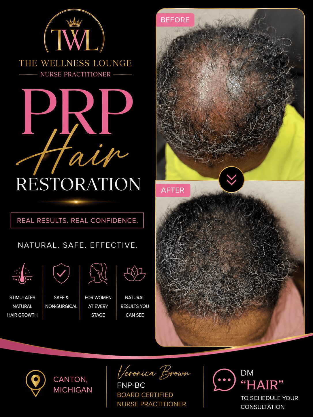 Before and after images of a person's scalp showing hair restoration results, with text about PRP hair treatment, in black and pink design.