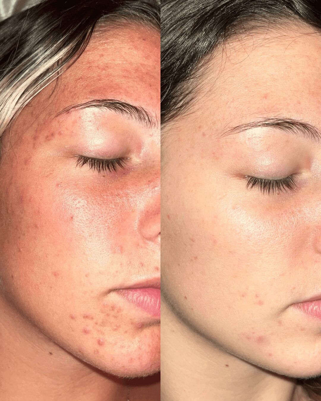 Side-by-side comparison of a woman's face showing acne before and after treatment, with clear skin in the after image.