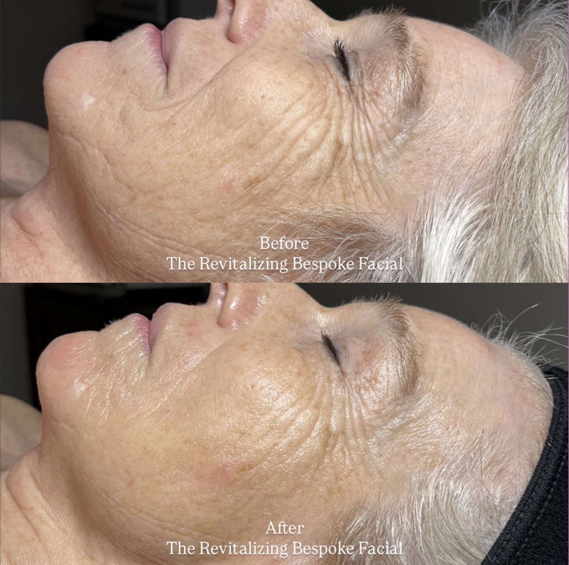 Side-by-side comparison of a woman's face before and after facial treatment, showing reduced wrinkles and smoother skin.