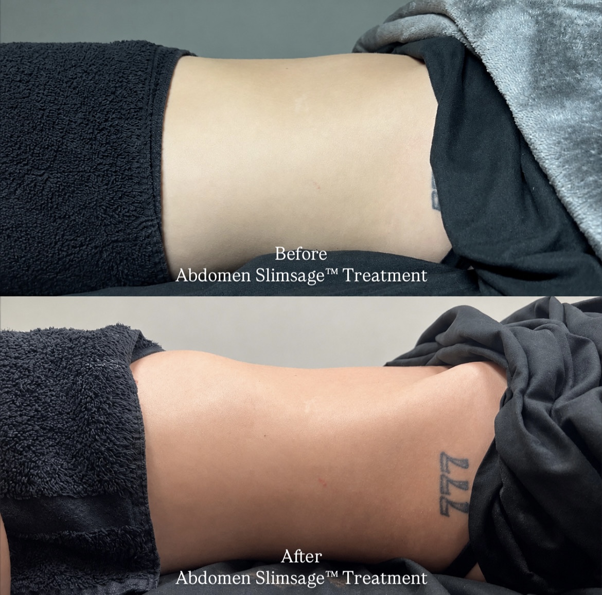 Comparison of abdomen before and after Slimsage treatment showing reduction in size, with visible skin and clothing differences.