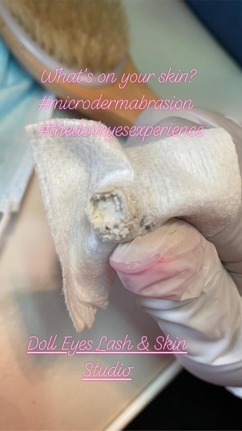 Close-up of a hand holding a small device, with text overlay about skin and dermabrasion, at a skincare studio.