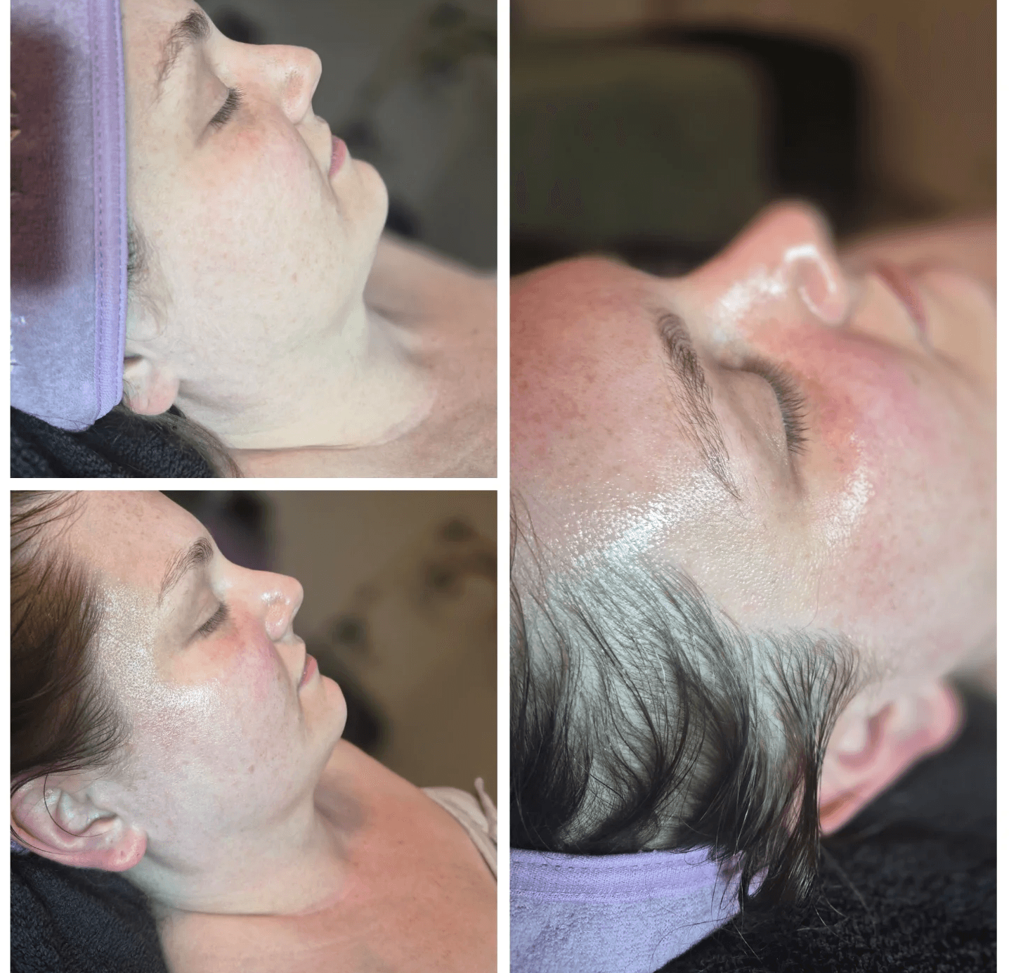Four close-up side profiles of a woman lying down with eyes closed, showing different skin conditions and hair colors.