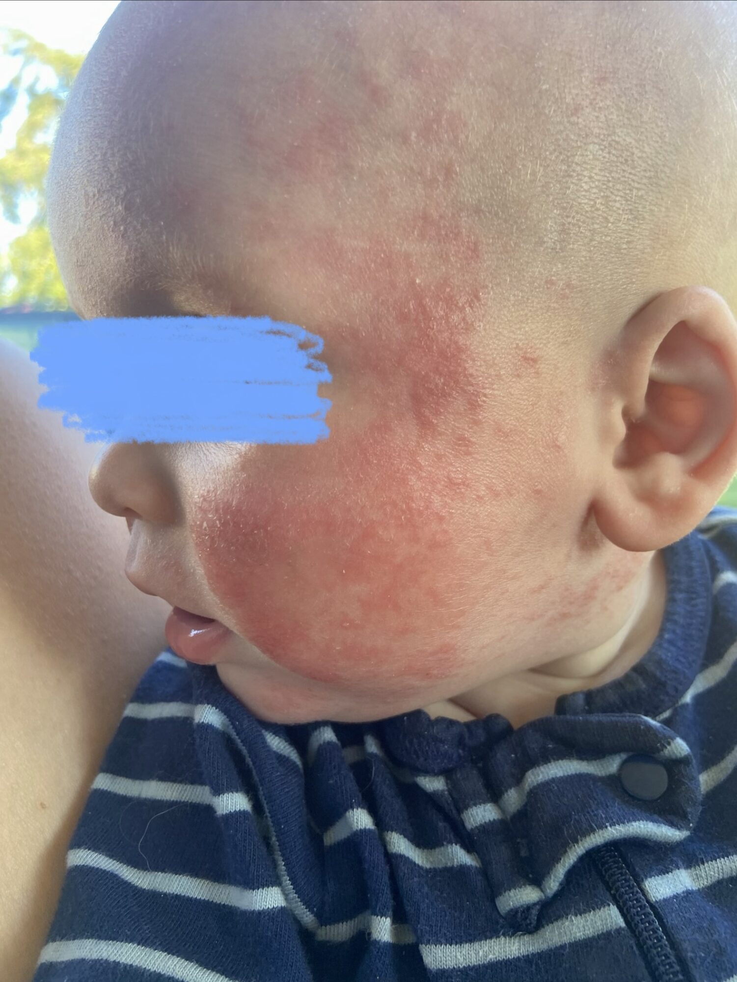 Child with red, irritated skin on face and scalp, wearing a striped shirt, outdoors with blurred background.