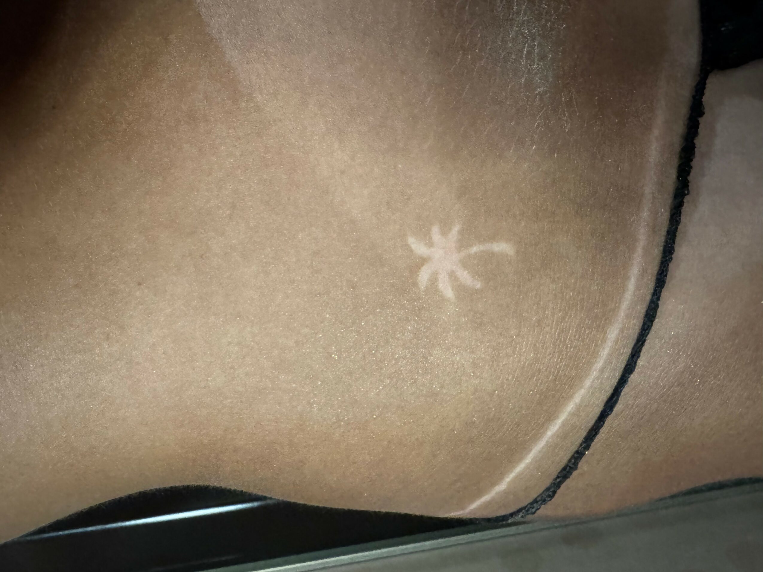 Close-up of a person's skin with a small white star-shaped mark, and a black line nearby.