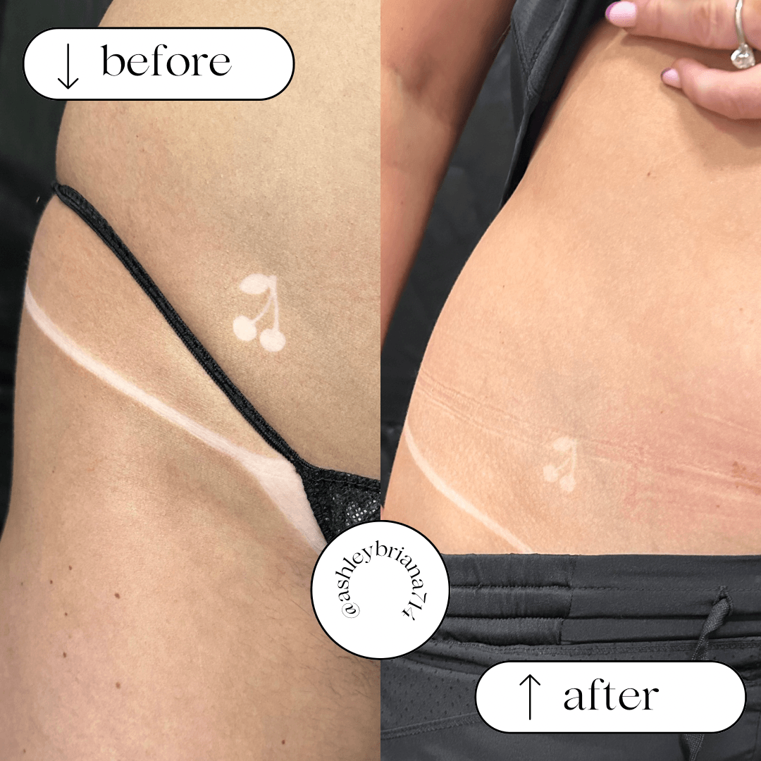 Comparison of skin with a scar before and after treatment, showing improvement. Word count: 20. Confidence: 0.9